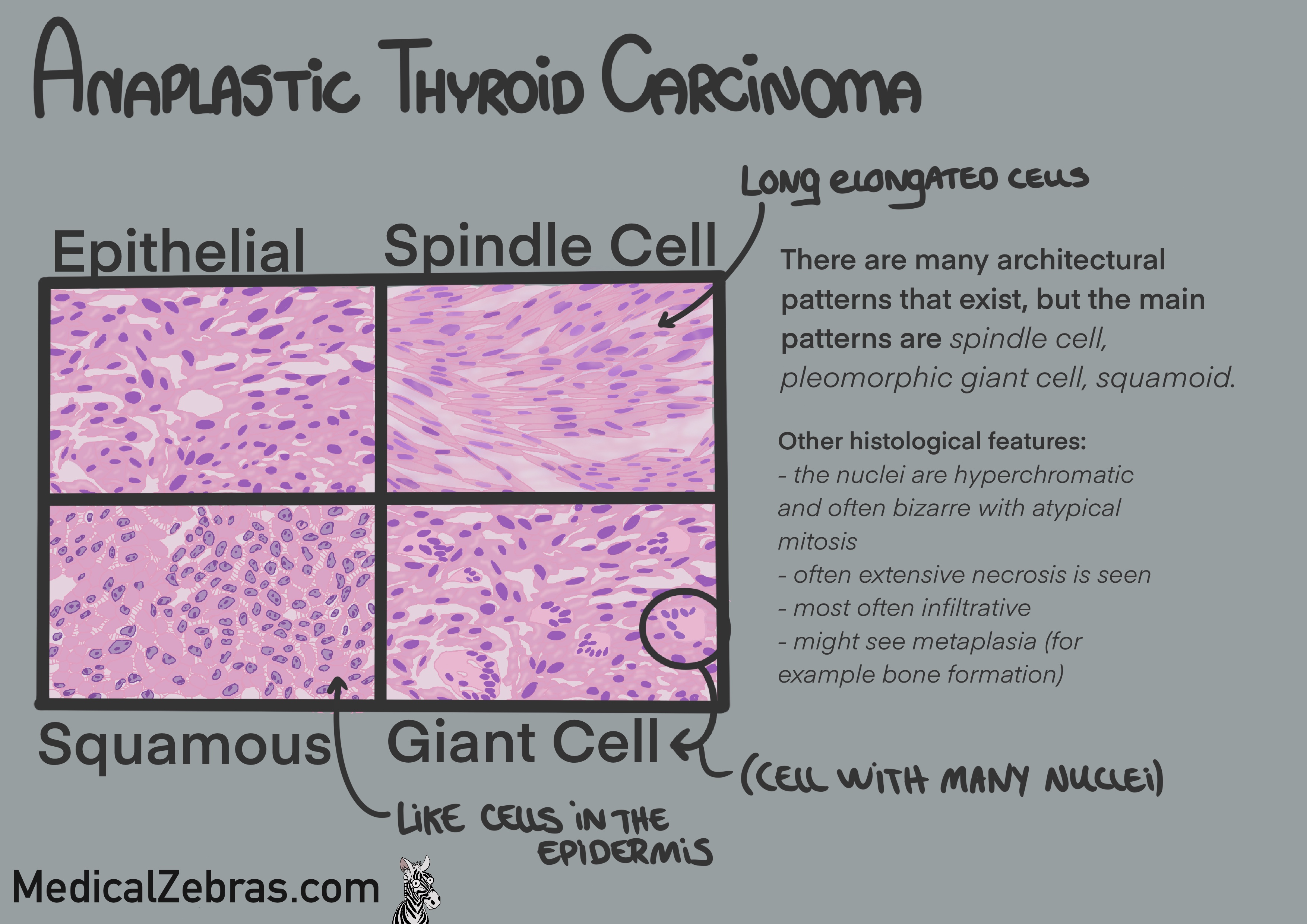 Anaplastic thyroid carcinoma histology pathology explained