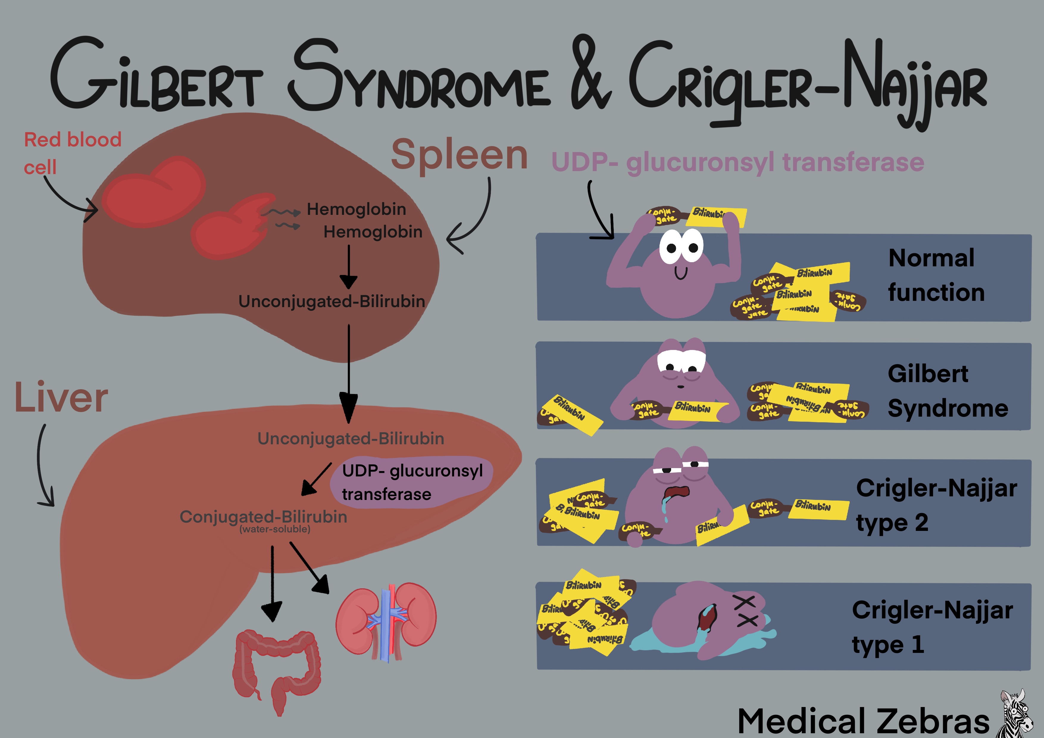 Gilbert syndrome and Crigler-Najjar syndrome explained easily