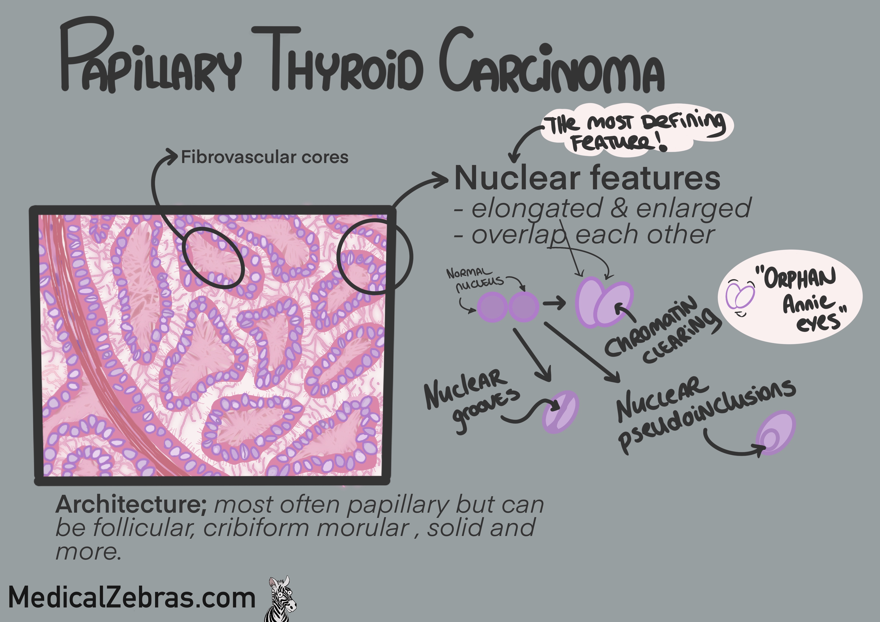 Papillary thyroid carcinoma histology pathology explained