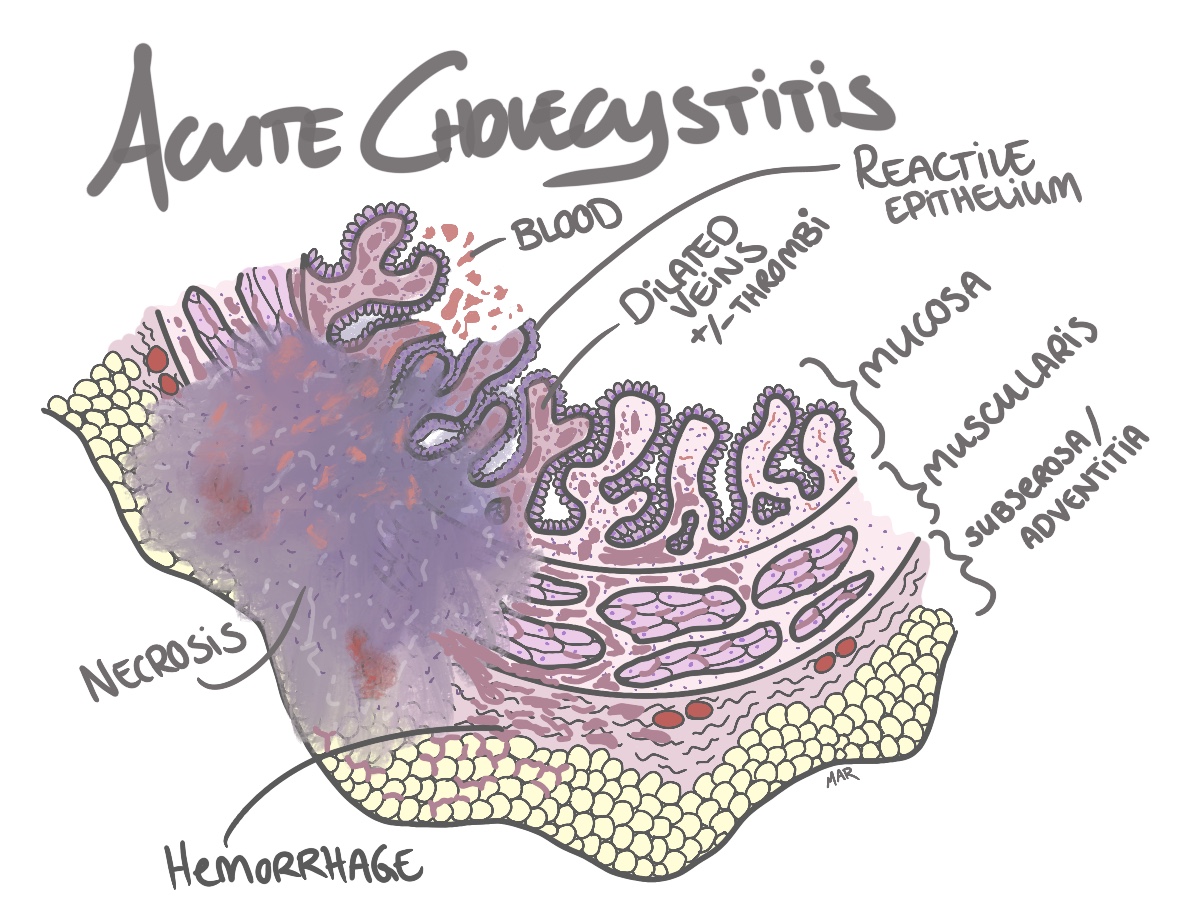 acute cholecystitis histology pathology