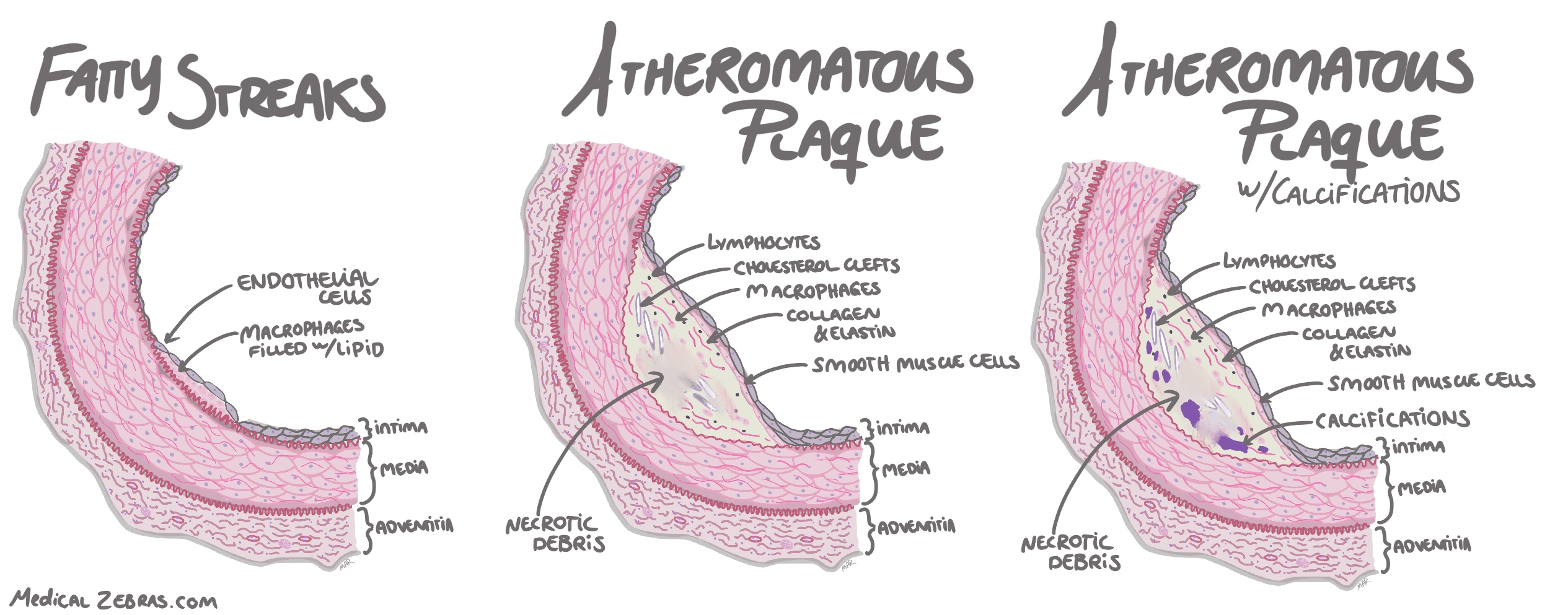 artherosclerosis histology