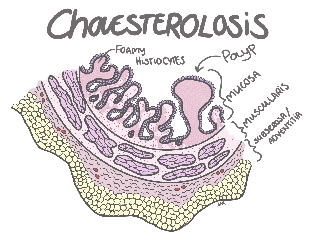 cholesterolosis histology pathology