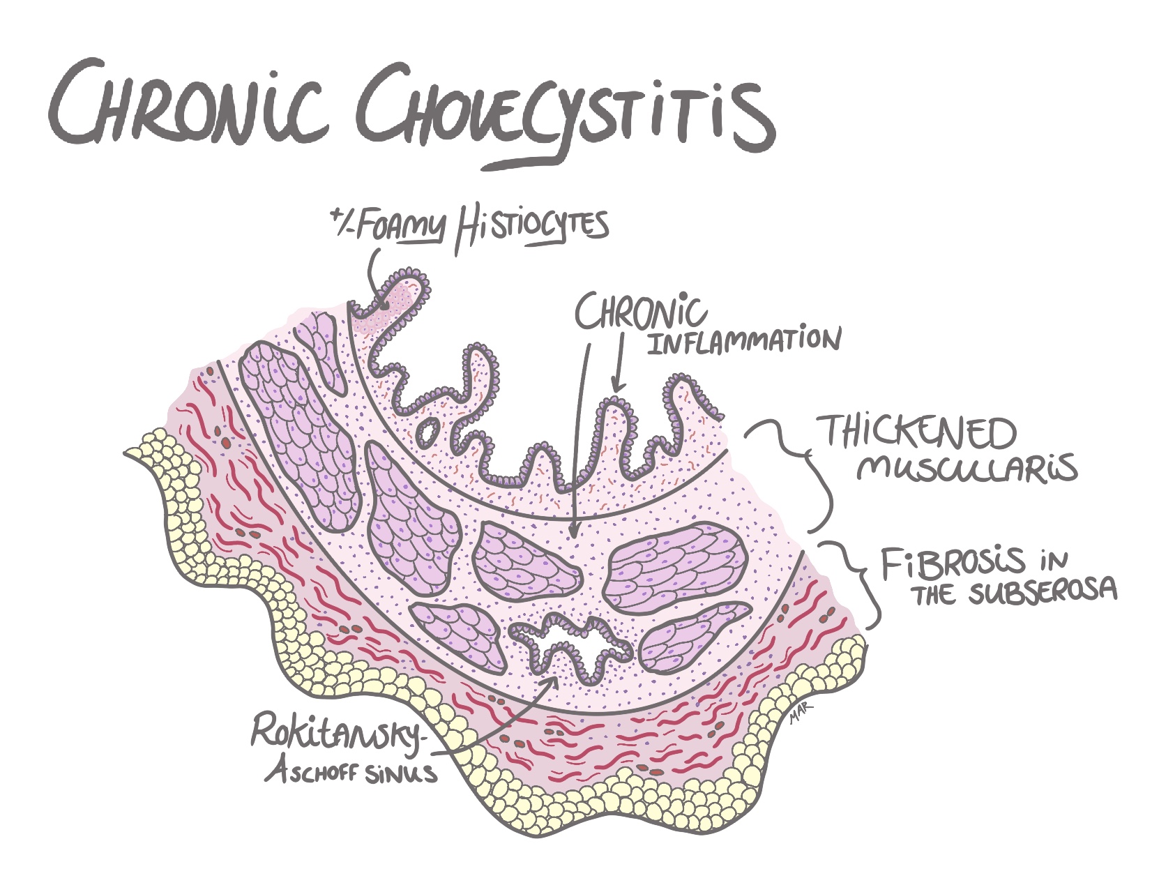 chronic cholecystitis histology pathology